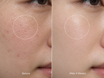 Close-up before and after 4 weeks of the Radiance Cleanser: clearer-looking pores